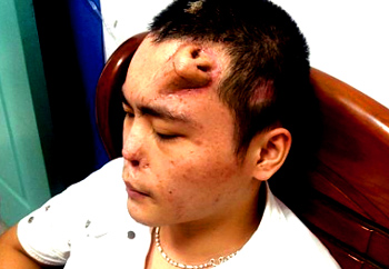 The patient, identified only as Xiaolian according to Reuters, has his nose damaged from an infection following a car accident. His doctors decided the only way to reconstruct his nose was to surgically form a new one on the 22-year-old’s forehead.  